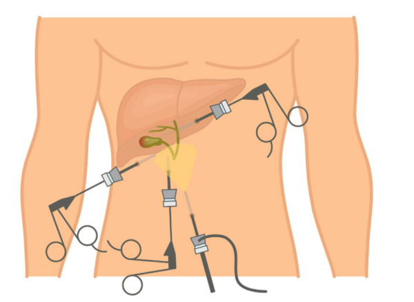 Colecistectomía por laparoscopia 